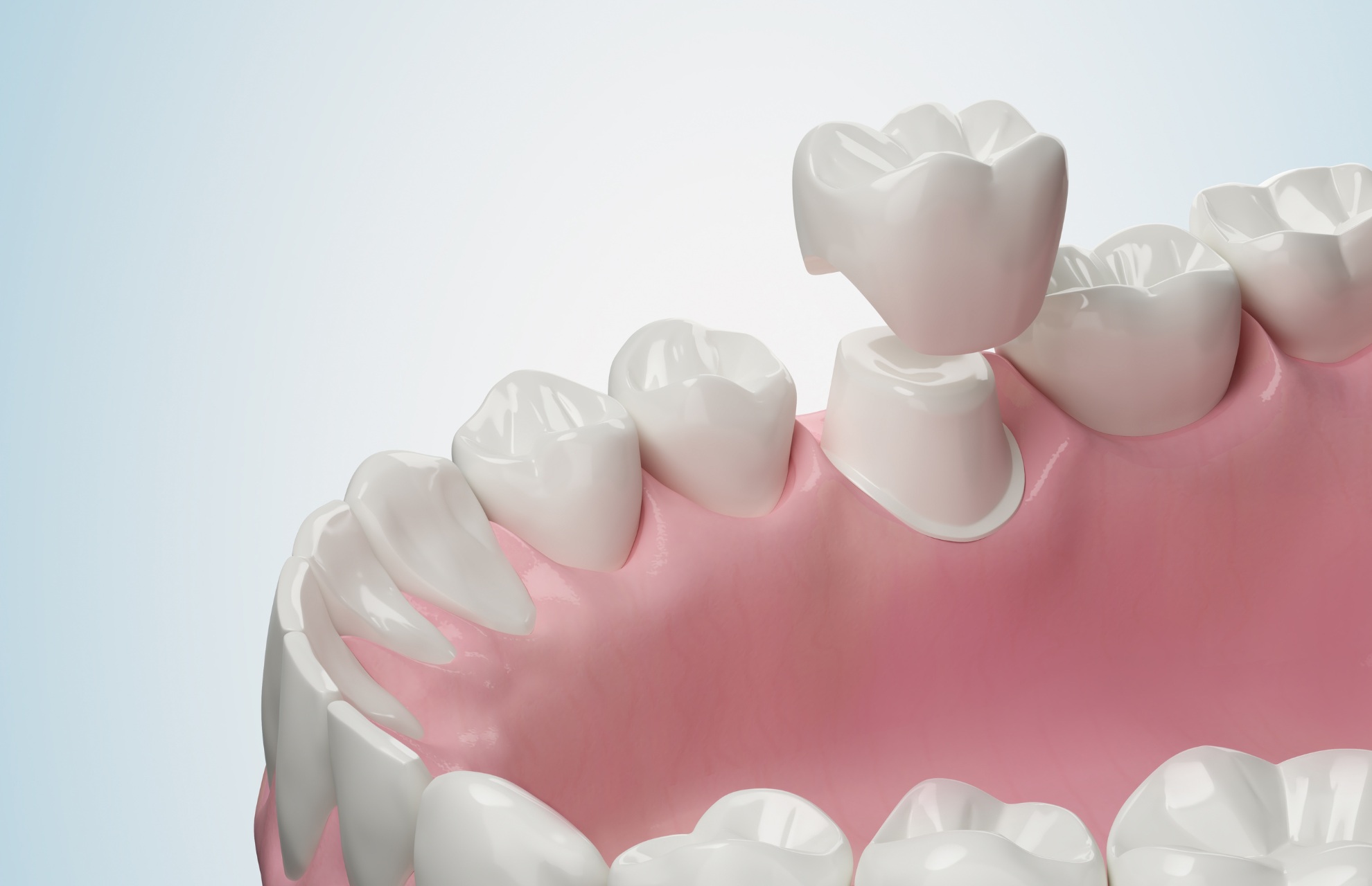 How Does a Prosthetic Dental Crown Protect a Damaged Tooth?