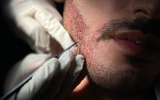 Eyebrow vs Beard Hair Growth: What to Expect After Transplant