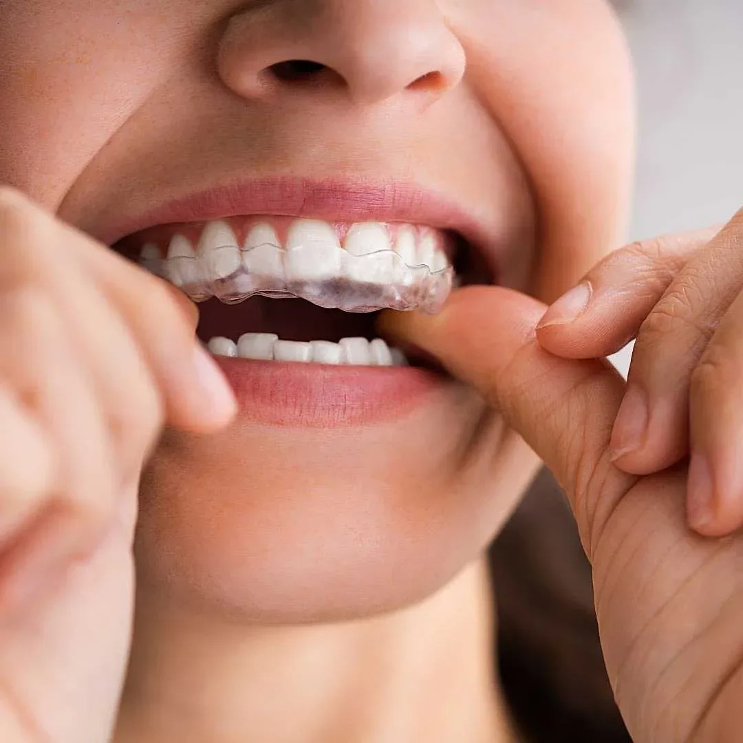 Night Guard in Dubai: Protect Your Smile While You Sleep
