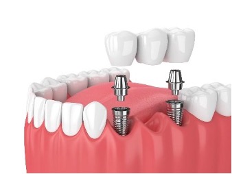 London, Ontario Dental Implants: Replace Lost Teeth | Quality Promise