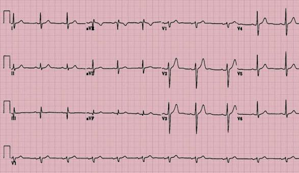 How Long Does It Take to Learn ECG Course?