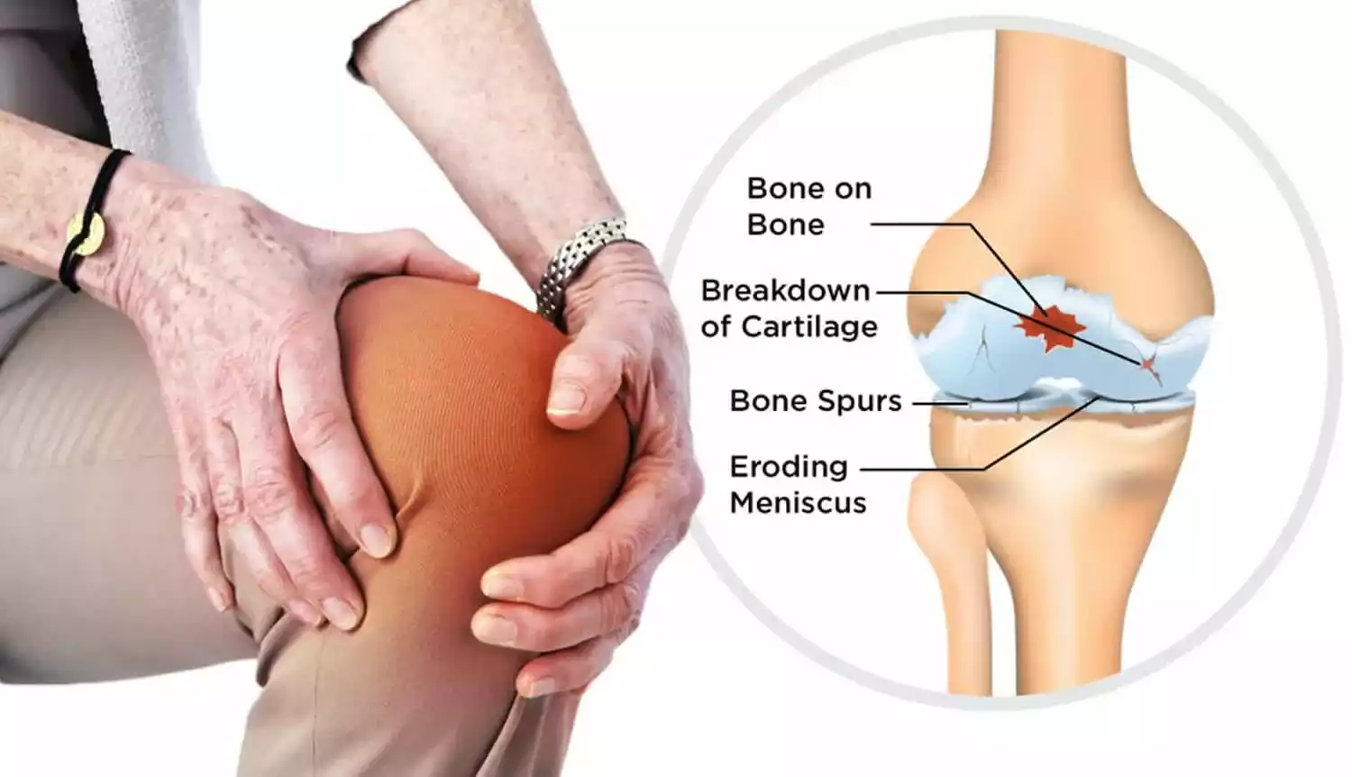 Knee Arthritis Treatment Cost and Care Options Mumbai