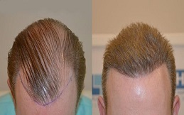 تكلفة زراعة الشعر في دبي: ما الذي تشمله الباقة العلاجية فعلياً؟