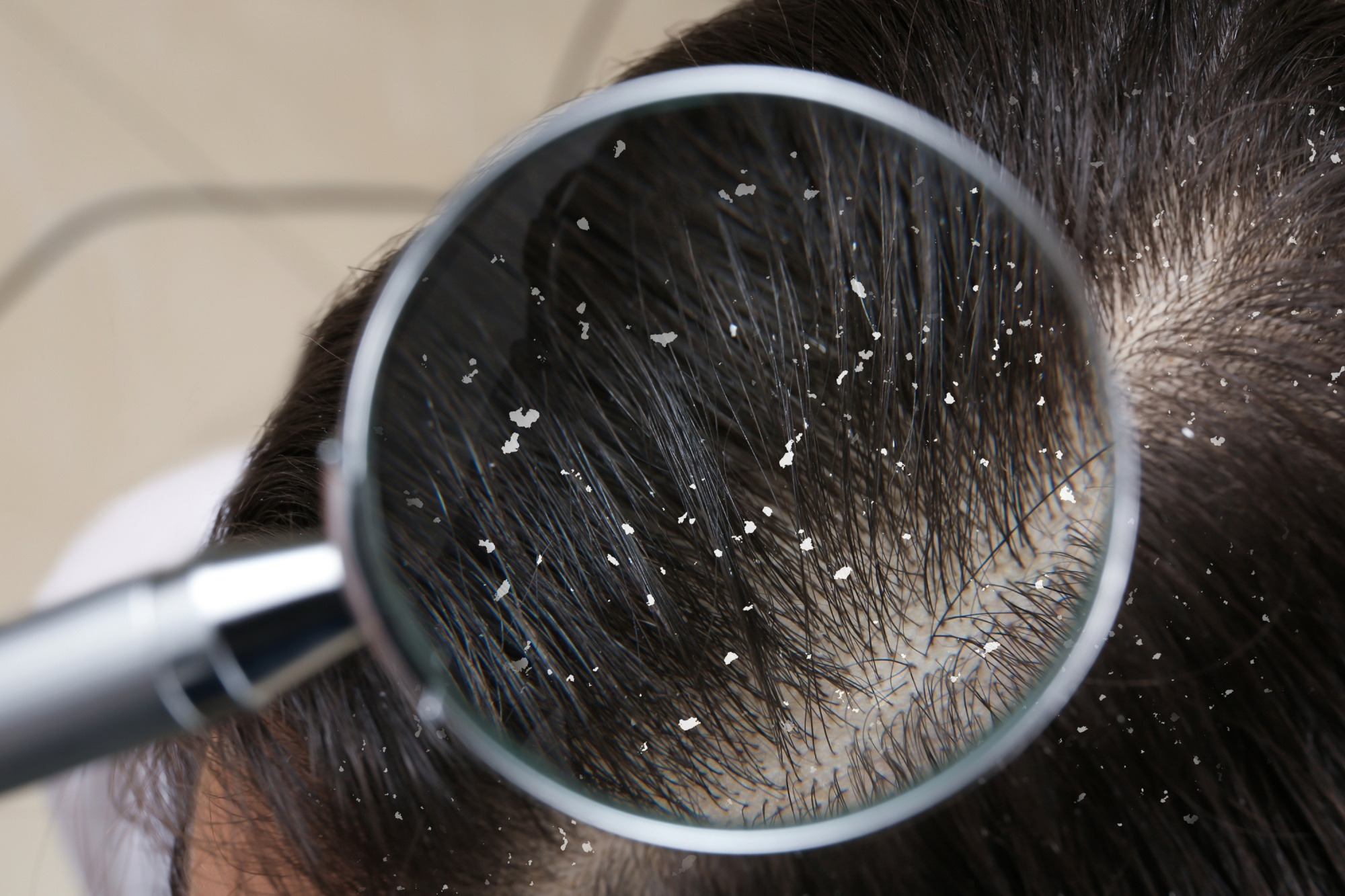 Complete Guide for Best Anti-Dandruff Shampoo & Hair Care