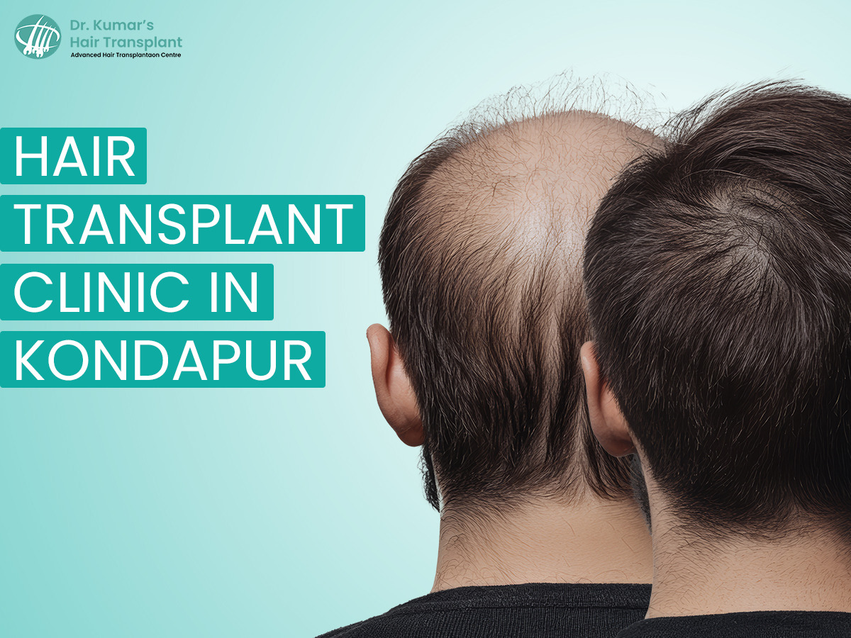 Why More People in Hyderabad Are Choosing Hair Transplant in Kondapur