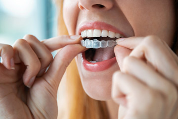 A Modern Smile Solution Beyond Traditional Braces