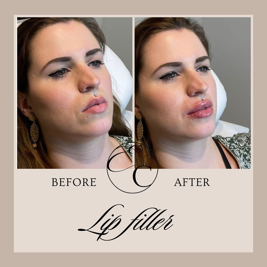 Scared of Looking Fake? A Belgian Expert's Guide to Natural Lip Filler Results for First-Time Patients