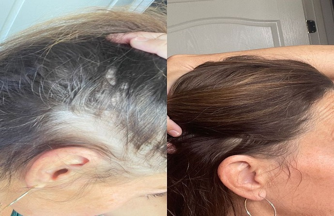 Hair Transplant in Dubai: Clinically Proven Procedures