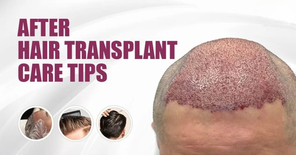How to Care for Your Transplanted Hair?