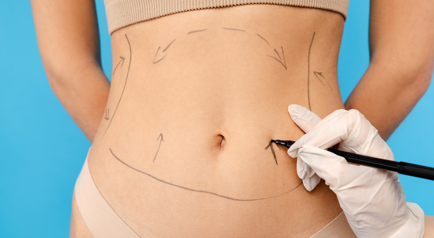 Liposuction Surgery in Miami: Are You a Good Candidate for the Procedure?