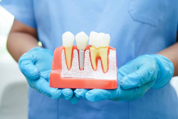 Better Oral Health Starts With Implants and Wisdom Removal