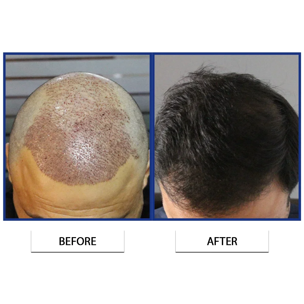 Is Hair Transplant Worth It? Everything You Need to Know Before the Procedure