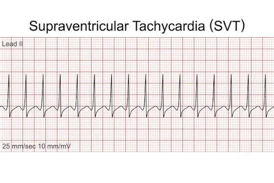 Why Is SVT Ablation Dubai Becoming the Preferred Choice for Treating Fast Heart Rhythms?