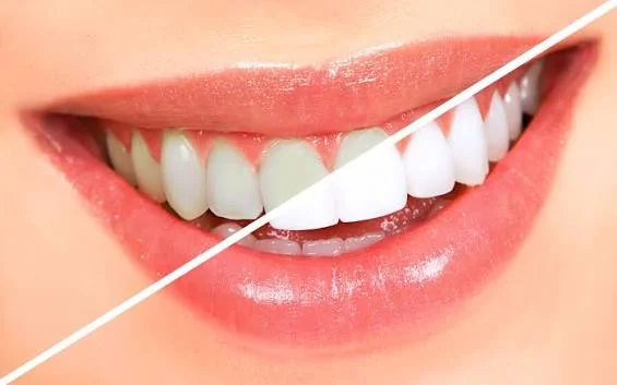 Teeth Whitening Toronto: Safe Ways to Brighten Your Smile