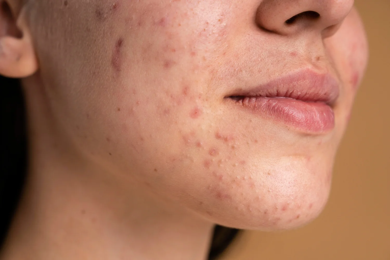 Which Acne Scar Treatment Is Best for Your Skin Type?