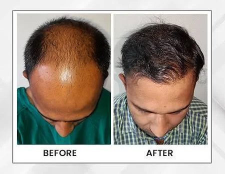 Hair Transplant in Jorhat | Is a Hair Transplant Worth It in Your 20s? – Dr. Pauls Online