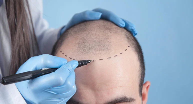 Hair Transplant in Kondapur: What Every Patient Should Know Before Deciding