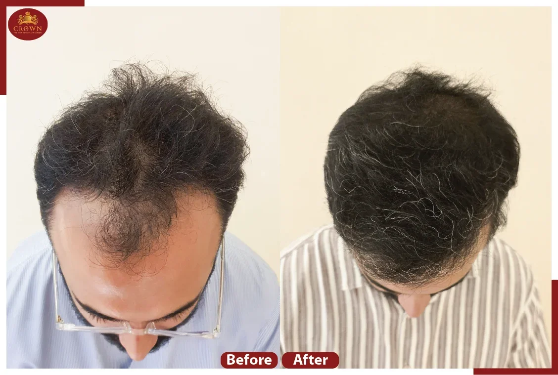 Hair Transplant in Delhi: Achieve Natural Hair Restoration with Crown - The Hair Transplant Experts
