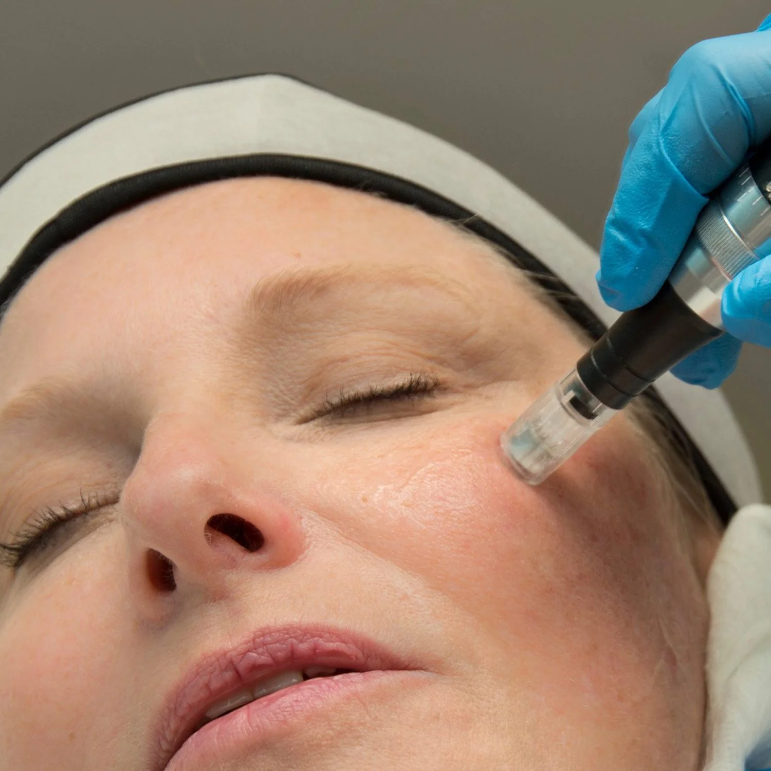 What Does Microneedling Do for the Face?