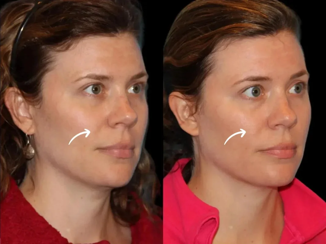 Sculptra in Dubai for Tissue Remodeling