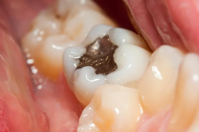 Cavities and Composite Fillings: A Complete Guide to Restoring Healthy Teeth
