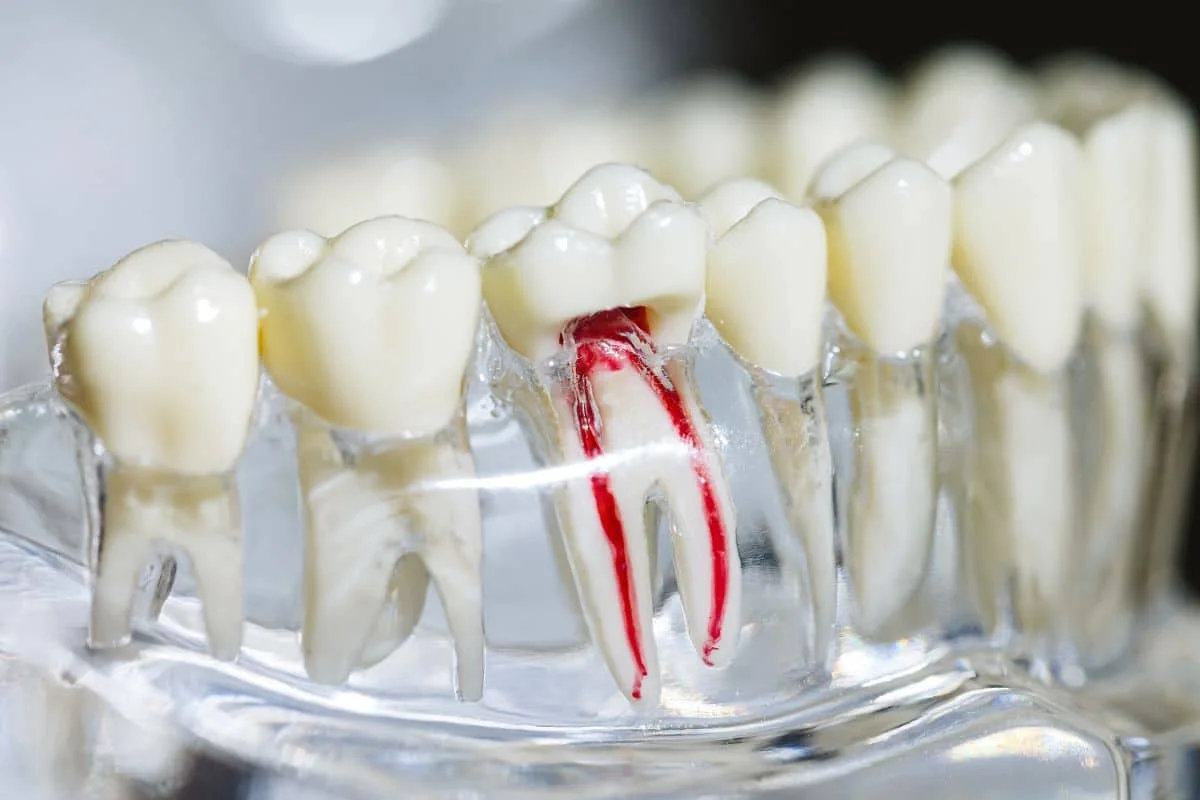 What You Should Know About Root Canal Treatments in Oxnard