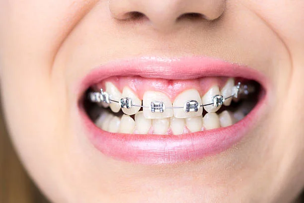 Braces and personalized orthodontic treatment for growing smiles