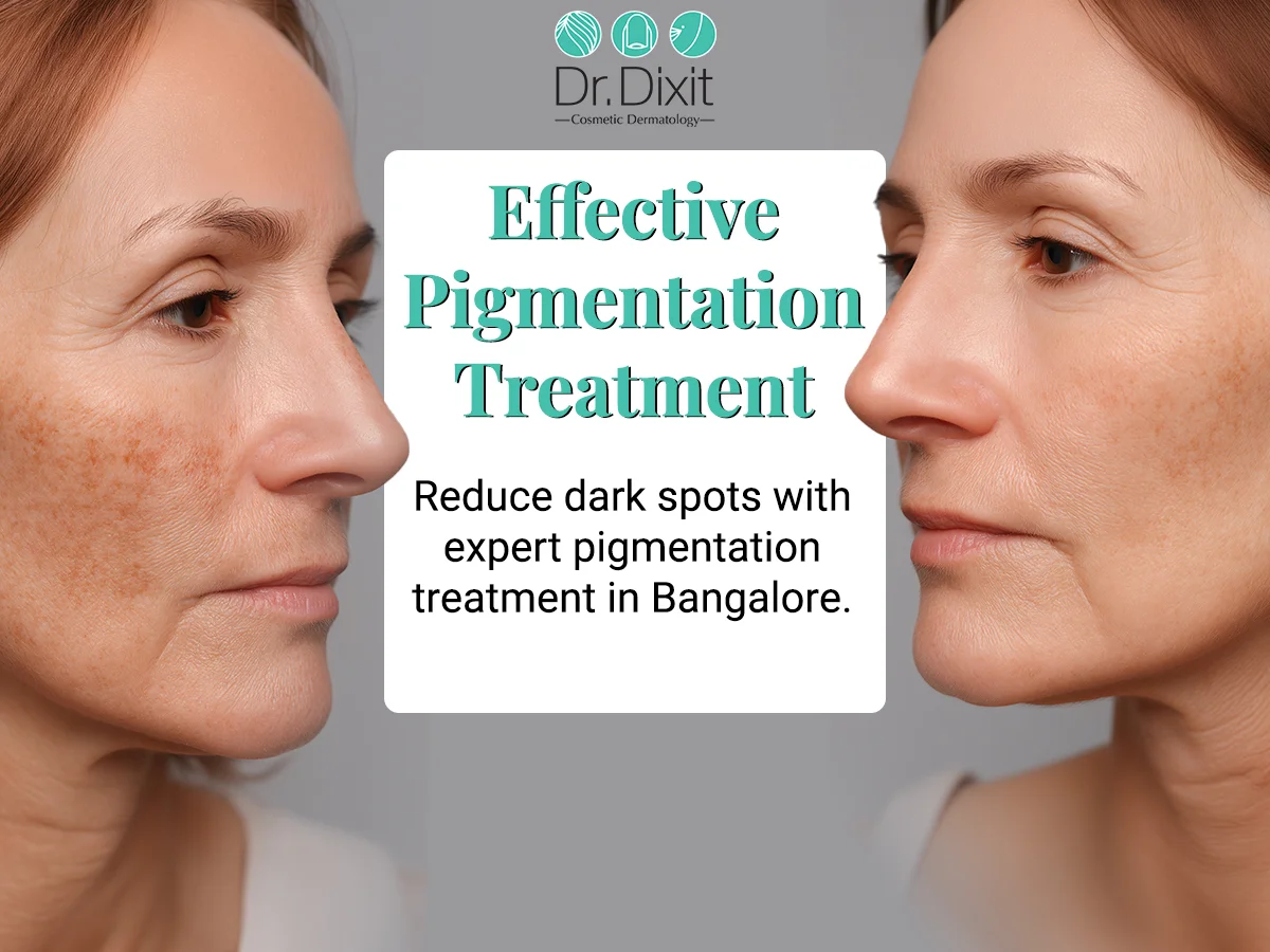 Why Pigmentation Can Be Especially Stubborn on Indian Skin