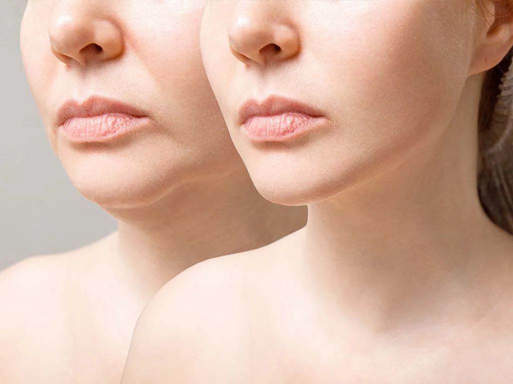 Addressing Postpartum Tissue Laxity and Hormonal Skin Changes