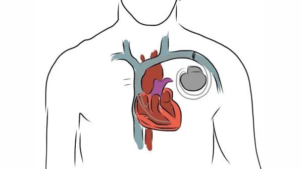 What Should You Know About an Internal Cardiac Defibrillator and Who May Need One?