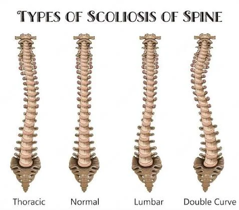 How Can You Choose the Right Doctor for Scoliosis Treatment in Abu Dhabi?