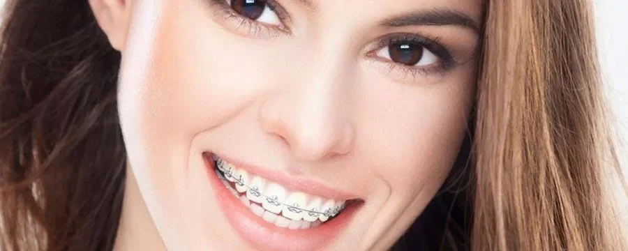 Ispravljanje zuba sa Invisalign-om naspram proteze: Šta je bolje?