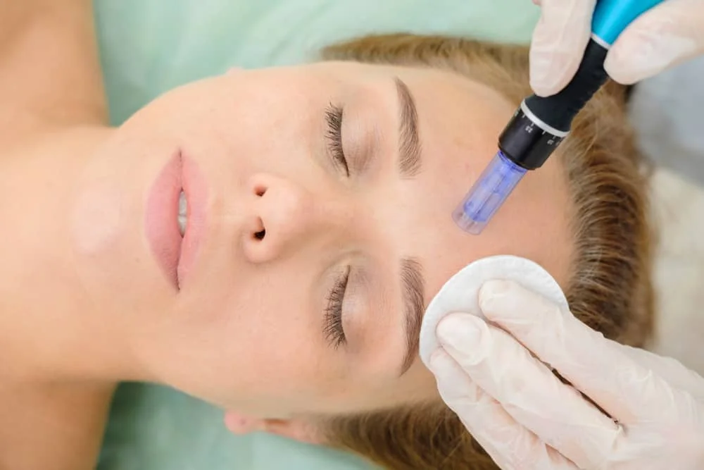 Microneedling Surrey: Your Guide to Smoother, Healthier Skin