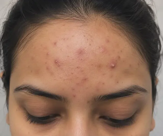 Struggling With Stubborn Acne? Find the Right Acne Treatment in Gurgaon