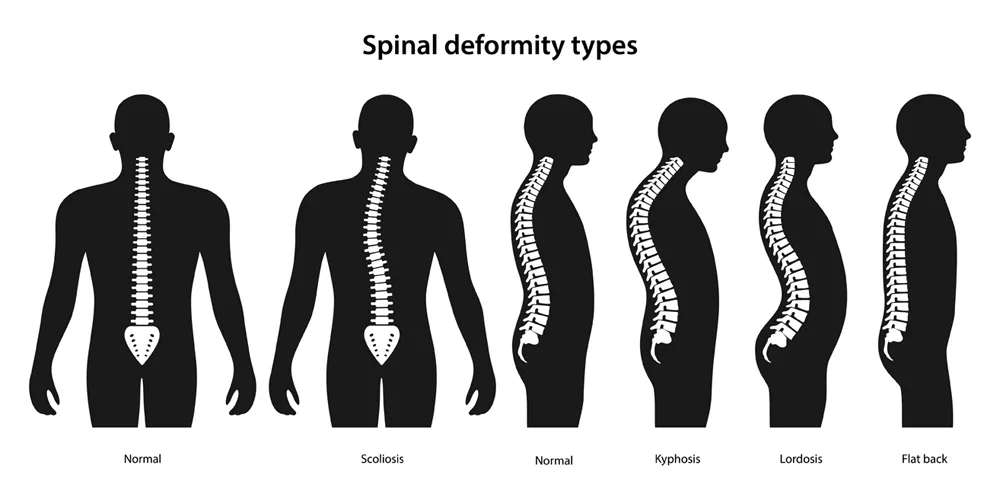 How Can Spinal Deformities in Children Be Diagnosed and Treated?