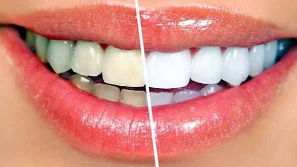 How Long Does Teeth Whitening Last? Tips to Maintain a Brighter Smile